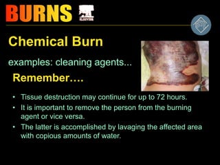 Burn management | PPT