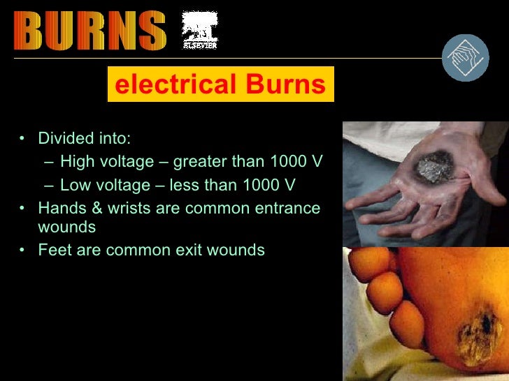 Burn management