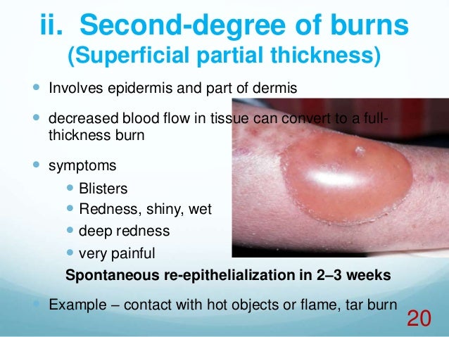 fourth degree burn treatment fourth degree burn treatment