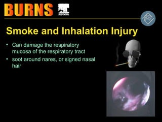 Soot Inhalation Injury Burn management Dr.Mahmoud Ameen | PPT