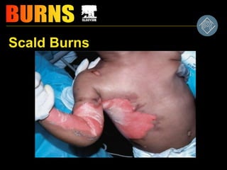 Scald Burns
 