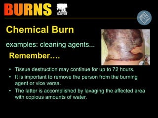 Chemical Burn
examples: cleaning agents...
Remember….
• Tissue destruction may continue for up to 72 hours.
• It is important to remove the person from the burning
agent or vice versa.
• The latter is accomplished by lavaging the affected area
with copious amounts of water.
 
