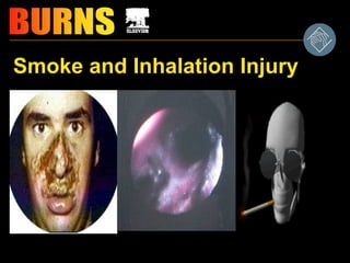Smoke and Inhalation Injury
 