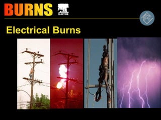 Electrical Burns
 