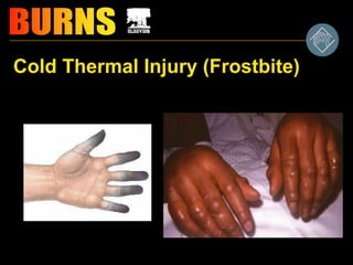 Cold Thermal Injury (Frostbite)
 