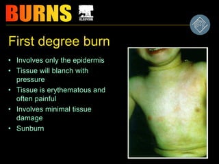 First degree burn
• Involves only the epidermis
• Tissue will blanch with
pressure
• Tissue is erythematous and
often painful
• Involves minimal tissue
damage
• Sunburn
 