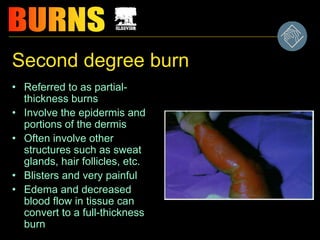 Second degree burn
• Referred to as partial-
thickness burns
• Involve the epidermis and
portions of the dermis
• Often involve other
structures such as sweat
glands, hair follicles, etc.
• Blisters and very painful
• Edema and decreased
blood flow in tissue can
convert to a full-thickness
burn
 