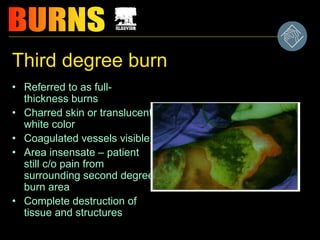 Third degree burn
• Referred to as full-
thickness burns
• Charred skin or translucent
white color
• Coagulated vessels visible
• Area insensate – patient
still c/o pain from
surrounding second degree
burn area
• Complete destruction of
tissue and structures
 