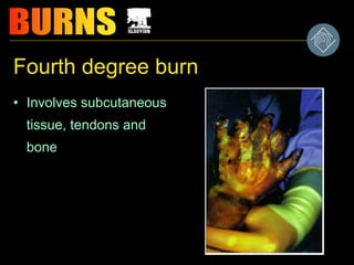 Fourth degree burn
• Involves subcutaneous
tissue, tendons and
bone
 