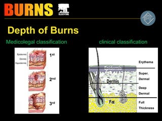 Depth of Burns
Medicolegal classification clinical classification
Erythema
Super.
Dermal
Deep
Dermal
Full
Thickness
1st
2nd
3rd
 