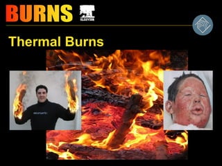 Thermal Burns
 
