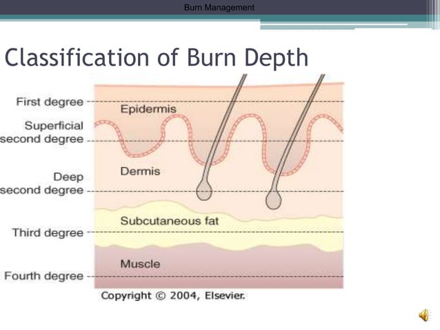 Burn management drneerajjain withaudio | PPT