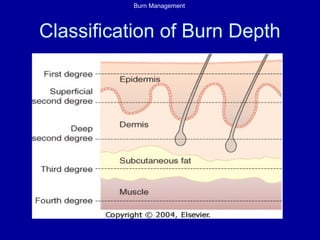 Burn Management
Classification of Burn Depth
 