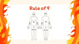 Rule of 9
 