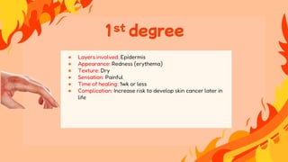 ● Layers involved: Epidermis
● Appearance: Redness (erythema)
● Texture: Dry
● Sensation: Painful
● Time of healing: 1wk or less
● Complication: Increase risk to develop skin cancer later in
life
1st degree
 