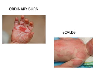 Burn ppt Dr Neha Jadhav | PPTX