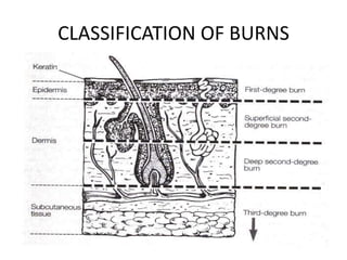 CLASSIFICATION OF BURNS
 
