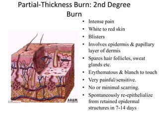 Partial-Thickness Burn: 2nd Degree
Burn
• Intense pain
• White to red skin
• Blisters
• Involves epidermis & papillary
layer of dermis
• Spares hair follicles, sweat
glands etc.
• Erythematous & blanch to touch
• Very painful/sensitive.
• No or minimal scarring.
• Spontaneously re-epithelialize
from retained epidermal
structures in 7-14 days
 