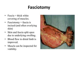 Fasciotomy
• Fascia = thick white
covering of muscles.
• Fasciotomy = fascia is
incised (and often overlying
skin)
• Skin and fascia split open
due to underlying swelling.
• Blood flow to distal limb is
improved.
• Muscle can be inspected for
viability.
 