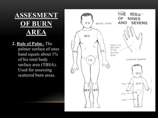 ASSESMENT
OF BURN
AREA
2. Rule of Palm– The
palmer surface of ones
hand equals about 1%
of his total body
surface area (TBSA).
Used for assessing
scattered burn areas.
 
