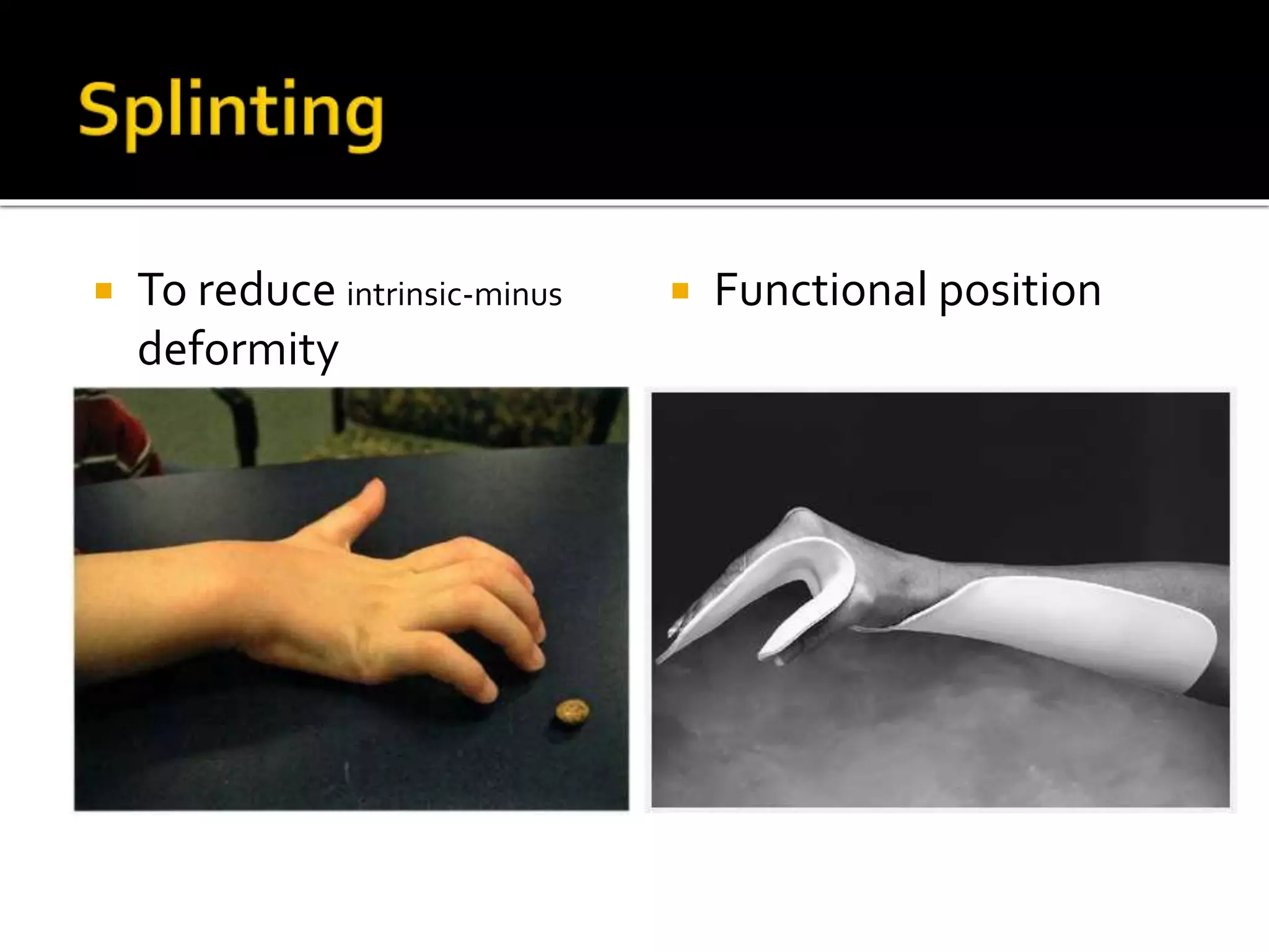 Burn rehabilitation | PPTX