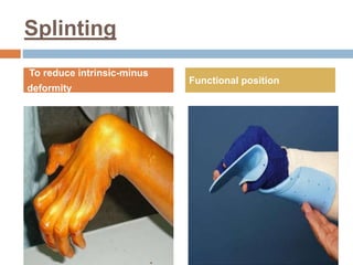 Burn rehabilitation | PPTX
