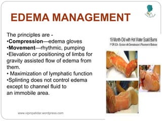 EDEMA MANAGEMENT
The principles are -
•Compression—edema gloves
•Movement—rhythmic, pumping
•Elevation or positioning of limbs for
gravity assisted flow of edema from
them.
• Maximization of lymphatic function
•Splinting does not control edema
except to channel fluid to
an immobile area.
www.vipinpatidar.wordpress.com
 