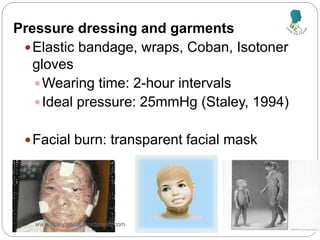 Pressure dressing and garments
Elastic bandage, wraps, Coban, Isotoner
gloves
Wearing time: 2-hour intervals
Ideal pressure: 25mmHg (Staley, 1994)
Facial burn: transparent facial mask
www.vipinpatidar.wordpress.com
 
