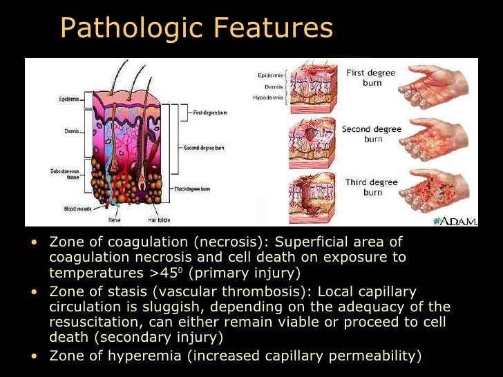 Burns pathophysiology-of-burns-flashcards-quizlet