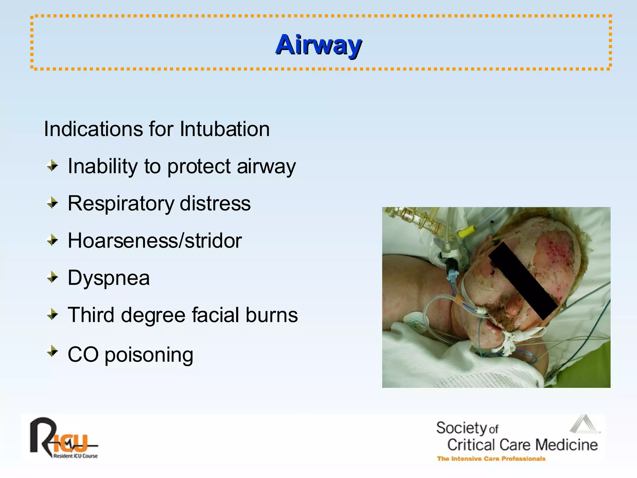 Airway Indications for Intubation Inability to protect airway Respiratory distress Hoarseness/stridor  Dyspnea Third degree facial burns CO poisoning   