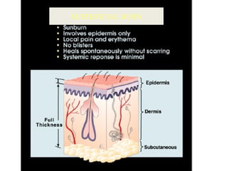 SUPERFICIAL BURN
 