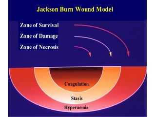 Jackson Burn Wound Model

Zone of Survival
Zone of Damage
Zone of Necrosis




                   Coagulation

                      Stasis
                   Hyperaemia
 