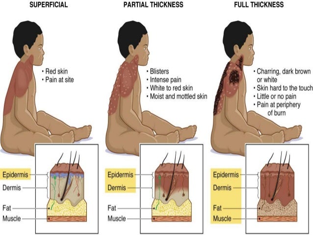 4th degree burn symptoms 4th degree burn symptoms