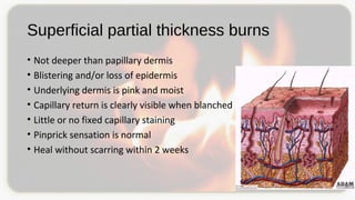 Superficial partial thickness burns
• Not deeper than papillary dermis
• Blistering and/or loss of epidermis
• Underlying dermis is pink and moist
• Capillary return is clearly visible when blanched
• Little or no fixed capillary staining
• Pinprick sensation is normal
• Heal without scarring within 2 weeks
 