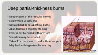Deep partial-thickness burns
• Deeper parts of the reticular dermis
• Epidermis is usually lost
• Not as moist as in superficial burns
• Abundant fixed capillary staining
• Color is not blenched with pressure
• Sensation may be reduced
• Takes 3 or more wks to heal without surgery
• May heal with hypertrophic scarring
 