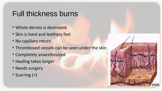 Full thickness burns
• Whole dermis is destroyed
• Skin is hard and leathery feel
• No capillary return
• Thrombosed vessels can be seen under the skin
• Completely anaesthesized
• Healing takes longer
• Needs surgery
• Scarring (+)
 