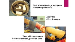 Soak silver dressings and gauze
in WATER (not saline).
Apply the
silver dressing.
Wrap with moist gauze.
Secure with mesh, gauze or tape.
 