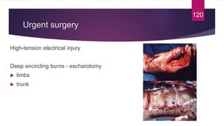 Urgent surgery
High-tension electrical injury
Deep encircling burns - escharotomy
 limbs
 trunk
120
 