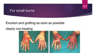 For small burns
121
Excision and grafting as soon as possible
clearly non-healing
 