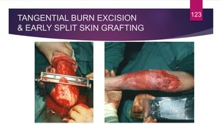 TANGENTIAL BURN EXCISION
& EARLY SPLIT SKIN GRAFTING
123
 