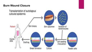 Burn Wound Closure
 