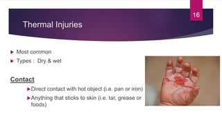 Thermal Injuries
 Most common
 Types : Dry & wet
Contact
Direct contact with hot object (i.e. pan or iron)
Anything that sticks to skin (i.e. tar, grease or
foods)
16
 