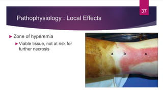 Pathophysiology : Local Effects
 Zone of hyperemia
 Viable tissue, not at risk for
further necrosis
37
 