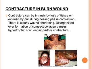 CONTRACTURE IN BURN WOUND
 Contracture can be intrinsic by loss of tissue or
extrinsic by pull during healing phase contraction..
There is clearly wound shortening. Disorganised
over formation of compact collagen causes
hypertrophic scar leading further contracture..
 