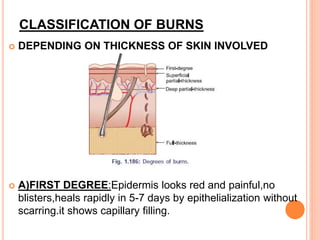 CLASSIFICATION OF BURNS
 DEPENDING ON THICKNESS OF SKIN INVOLVED
 A)FIRST DEGREE:Epidermis looks red and painful,no
blisters,heals rapidly in 5-7 days by epithelialization without
scarring.it shows capillary filling.
 