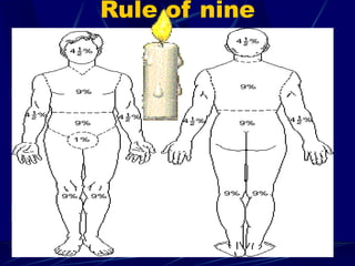 Rule of nine
 