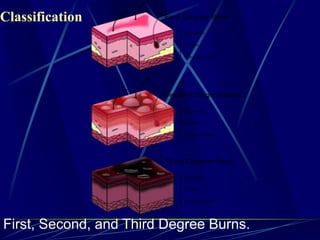 First, Second, and Third Degree Burns.
Classification
 
