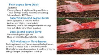 First-degree Burns (mild):
Epidermis
Pain, erythema & slight swelling, no blisters
Tissue damage usually minimal, no scarring
Pain resolves in 48-72 hours
Superficial Second-degree Burns:
Entire epidermis & variable dermis
Vesicles and blisters characteristic
Extremely painful due to exposed nerve endings
Heal in 7-14 days if without infection
Deep Second-degree Burns:
Few dermal appendages left
There are some fluid & metabolic effects
Full-thickness or Third-Degree:
Entire epidermis and dermis, no residual epidermis
Painless, extensive fluid & metabolic deficits
Heal only by wound contraction, if small, or if big, by
skin grafting or coverage by a skin flap
 