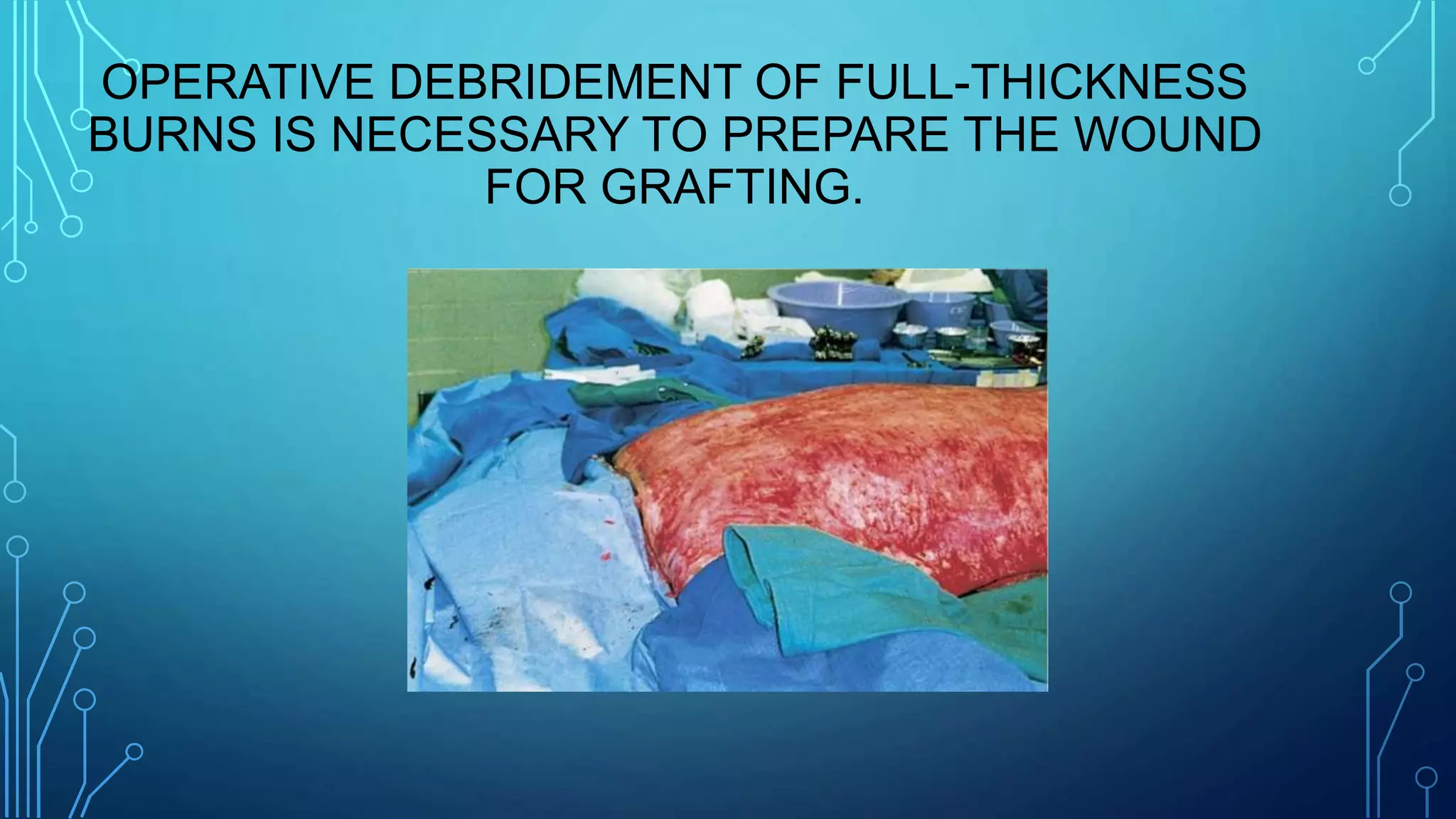 OPERATIVE DEBRIDEMENT OF FULL-THICKNESS
BURNS IS NECESSARY TO PREPARE THE WOUND
FOR GRAFTING.
 
