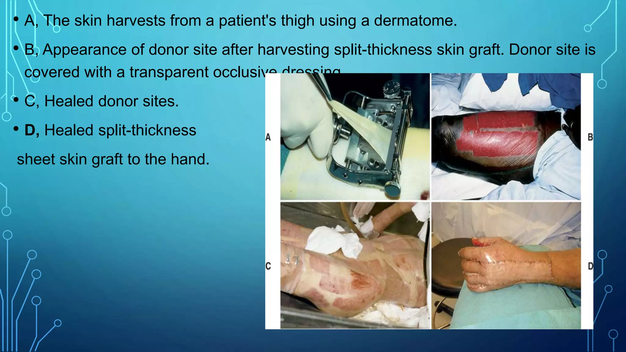 • A, The skin harvests from a patient's thigh using a dermatome.
• B, Appearance of donor site after harvesting split-thickness skin graft. Donor site is
covered with a transparent occlusive dressing.
• C, Healed donor sites.
• D, Healed split-thickness
sheet skin graft to the hand.
 